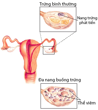 bệnh đa nang buồng trứng bệnh đa nang buồng trứng