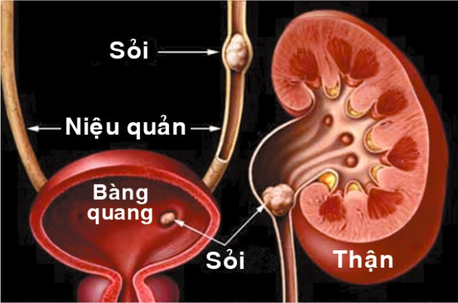 món ăn chữa sỏi tiết niệu