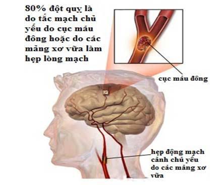 tai biến mạch máu não