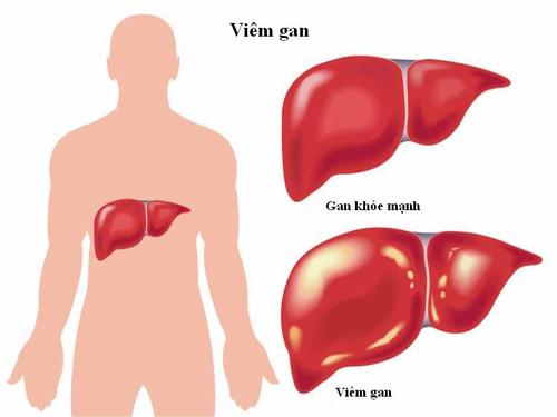 bệnh về gan