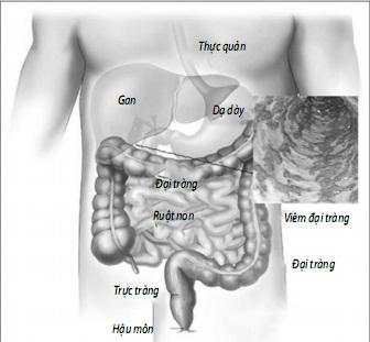 bệnh viêm đại tràng