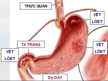viêm loét dạ dày